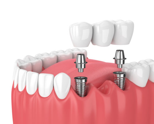 Emfiteymata_1 Dental Implants
