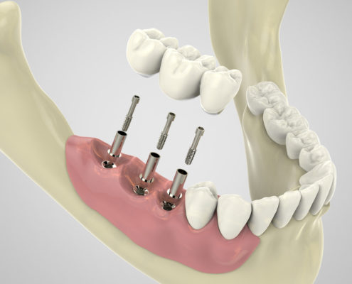 Emfiteymata_2 Dental Implants