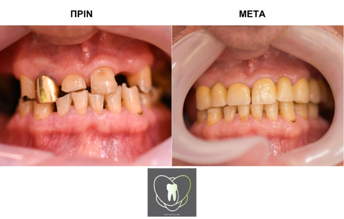 Πριν και Μετά