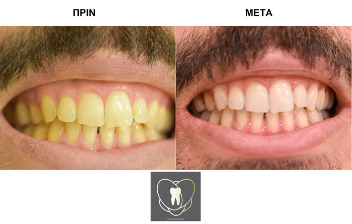 Πριν και Μετά