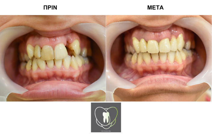 Πριν και Μετά