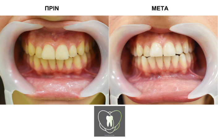 Πριν και Μετά