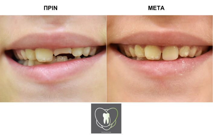 Πριν και Μετά