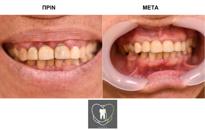 Πριν και Μετά