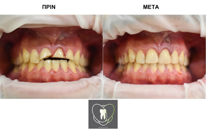 Πριν και Μετά