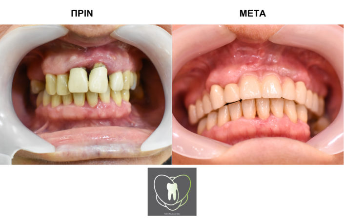 Πριν και Μετά