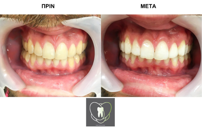 Πριν και Μετά