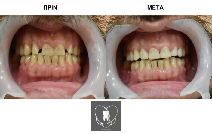 Πριν και Μετά